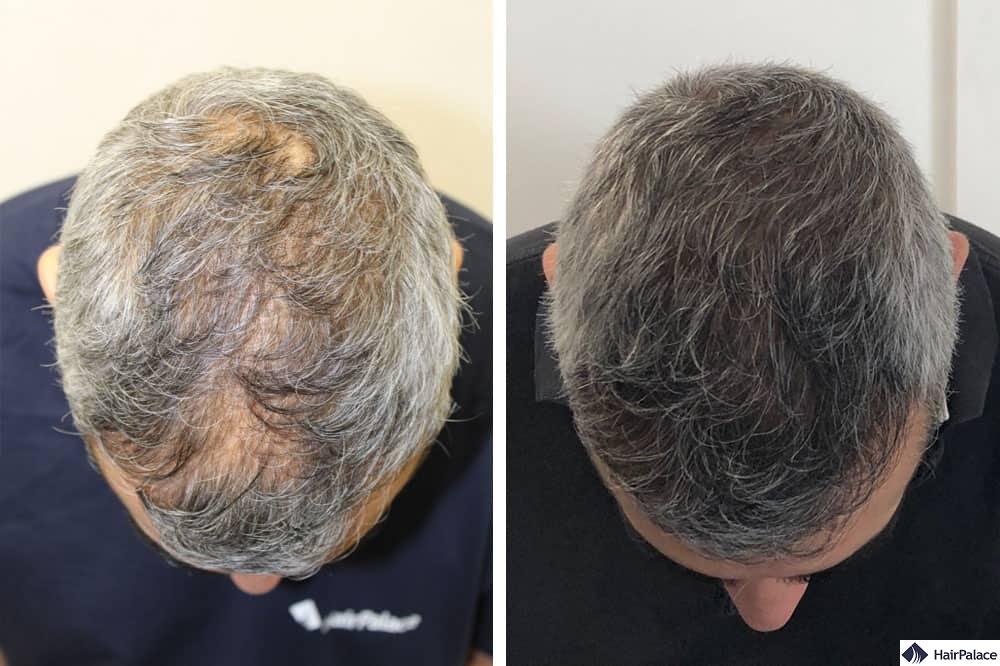 Revitalize Your Look with FUE at Westminster Medical