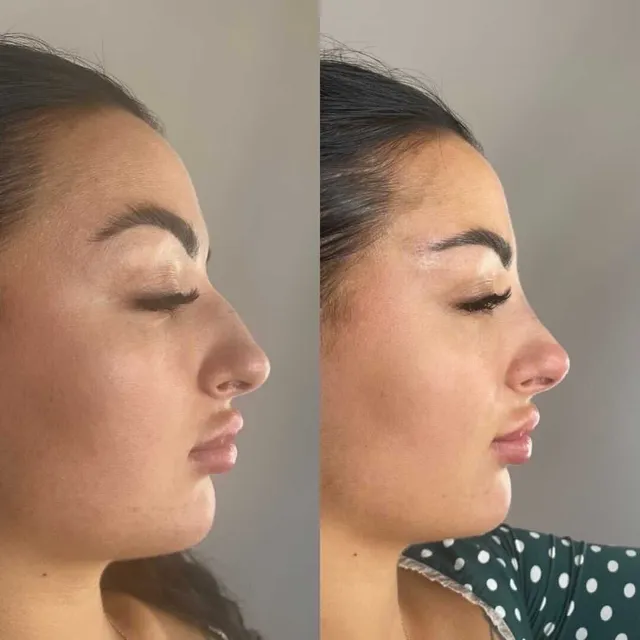 Hiko Nose Thread Lift Dubai Price: AED 1299 for Natural Beauty